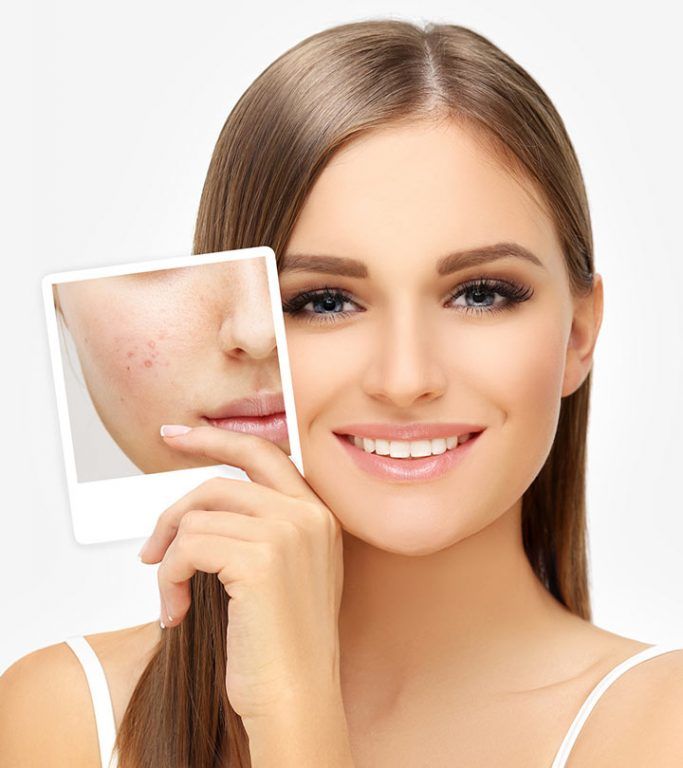 Acne Treatment